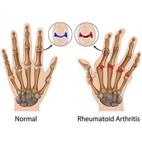 Copper Gloves for Arthritis Hands