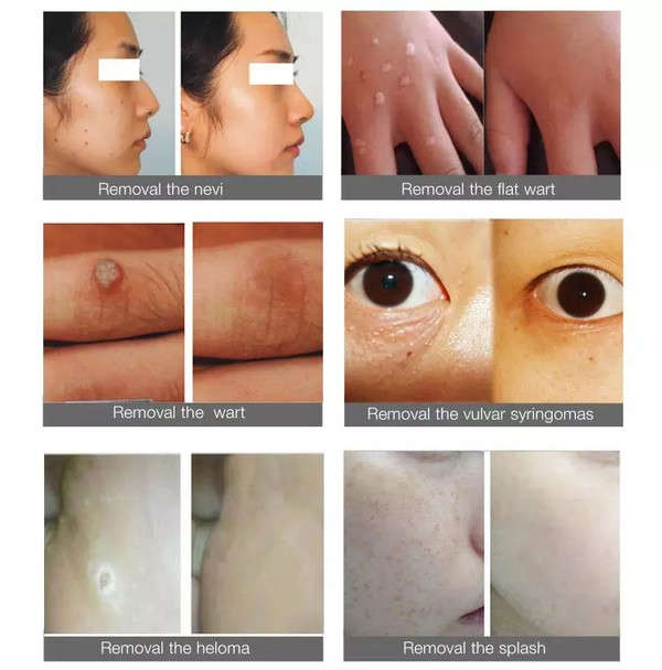 Beauty Mole Removal Sweep Spot Pen