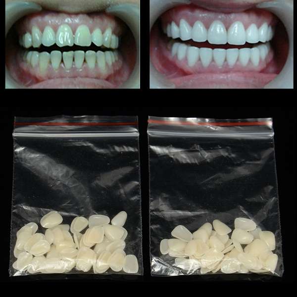100pcs Temperary Ultra Thin Resin Whitening Dental Veneers for Upper Anterior T