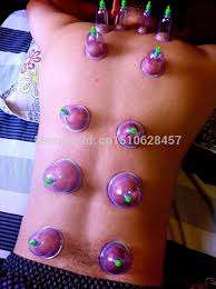 Image result for chinese cupping therapy