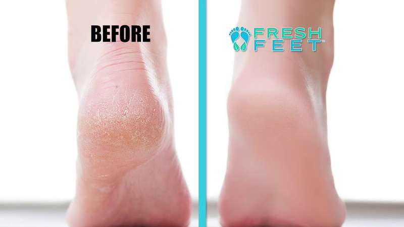 *New * Fresh Feet Foot Scrubber