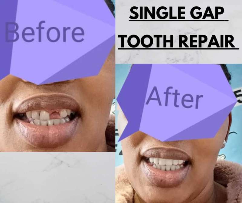 Tooth Repair Kit repair 1 Gap Temporary