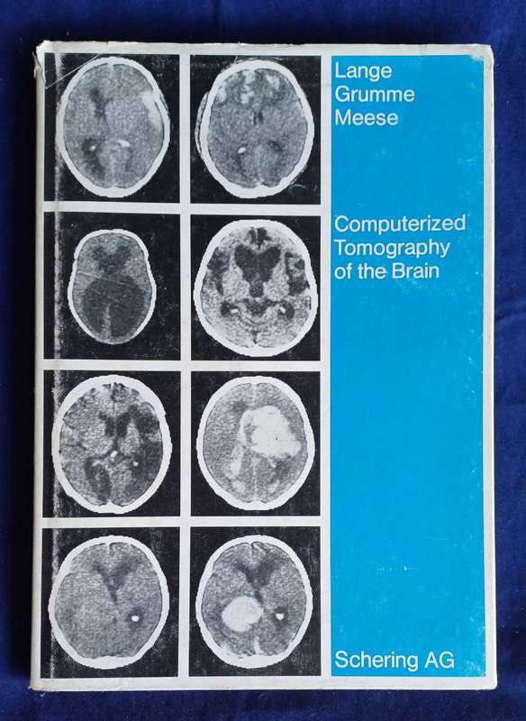 Computerized tomography of the brain