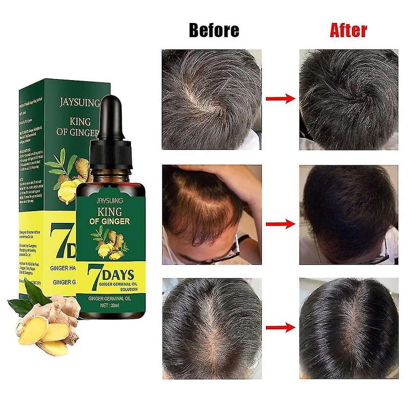 Jaysuing King of Ginger 7 Days Ginger Hair Growth Essene Oil For Damaged Hair - 30ml