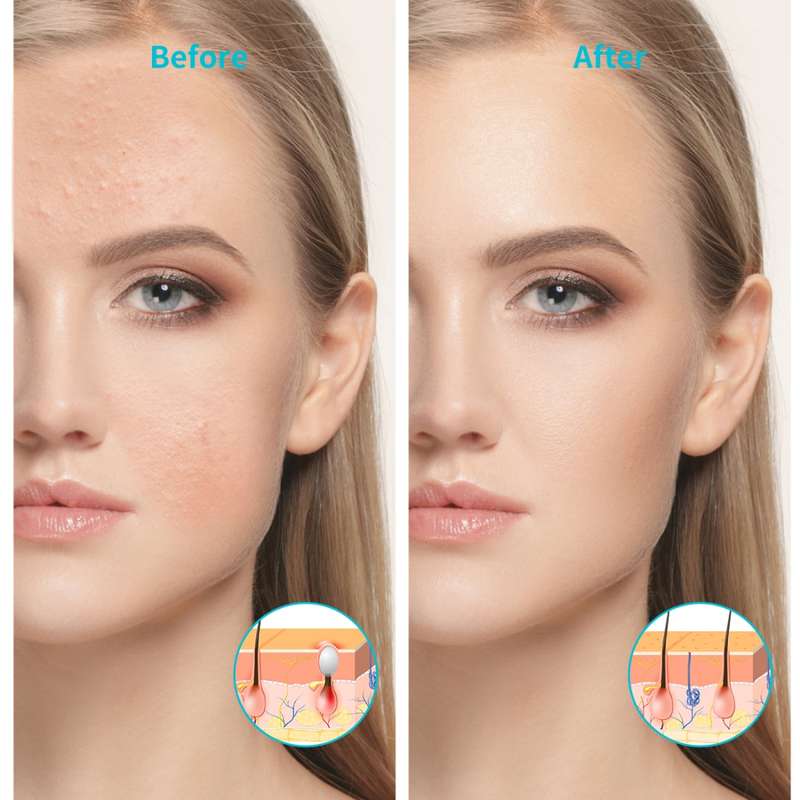 XPREEN XPRE052 Wireless Rechargeable Light Acne Treatment Device Home Acne Clearing Eraser with Blue