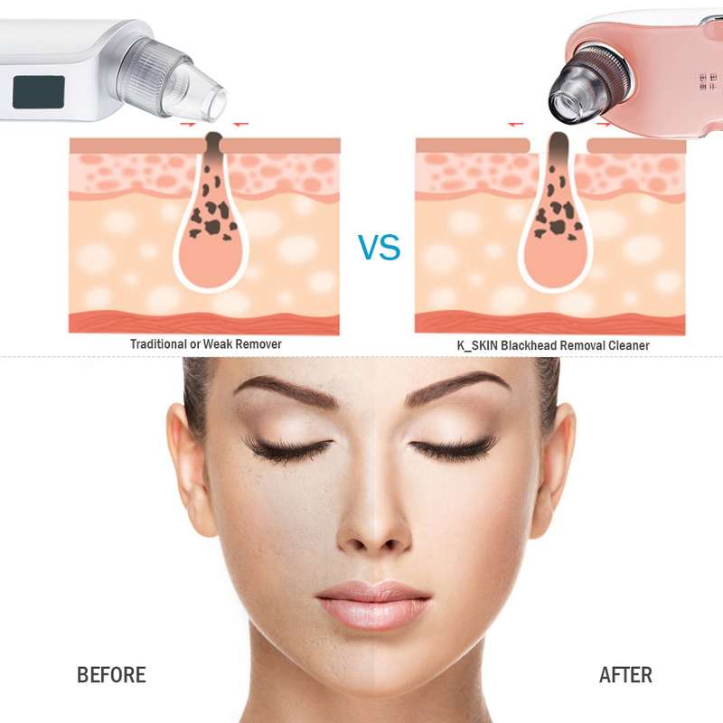 K-SKIN KD803A 3 Level Intensity Blackhead Removal Pore Cleaner Suction Rechargeable Black Spot Clean