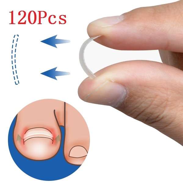 Ingrown Toenail Straightening Clip Curved BS Brace Toenails Thick Paronychia Correction Tool About 1