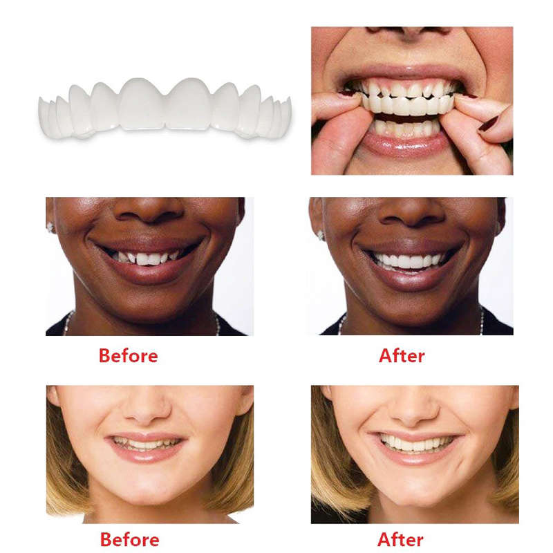 1 Pair Dentistry Cosmetic Covers Smile Comfort Veneers Flex Teeth Braces Upper +Bottom