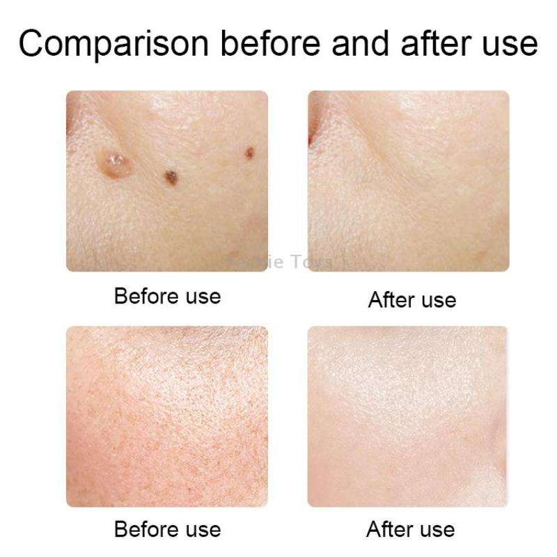 FY-106 Portable Mole and Freckle Removal Pen Household Laser Beauty Equipment(Green)