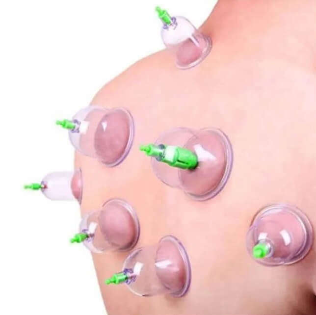 6 Pcs Chinese Body Cupping Massage Suction Therapy