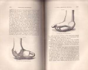 On the Nature and Treatment of the Deformities of the Human Frame. - Little, W.J.