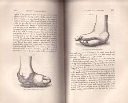 On the Nature and Treatment of the Deformities of the Human Frame. - Little, W.J.