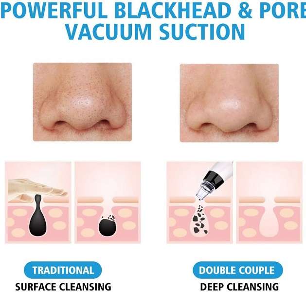 183716 Microcrystalline Black Head Remover