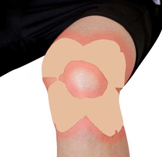 5 Large Patches Viopatch - Knee Pain Herbal Pain Relief