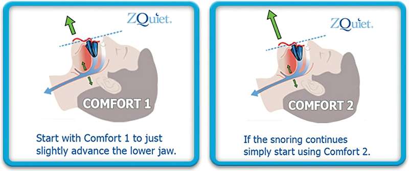 ZQuiet South Africa - Anti Snoring Mouthpiece