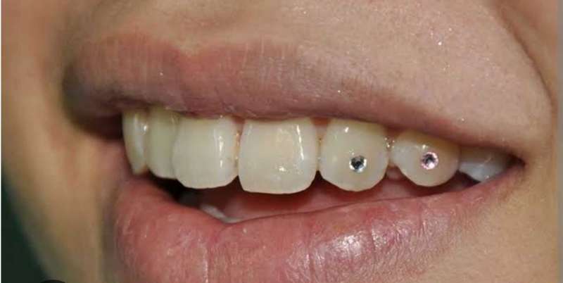 Tooth Gemstone DIY Kit