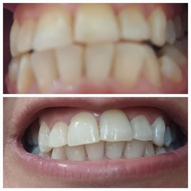 Teeth Whitening Smile Stick