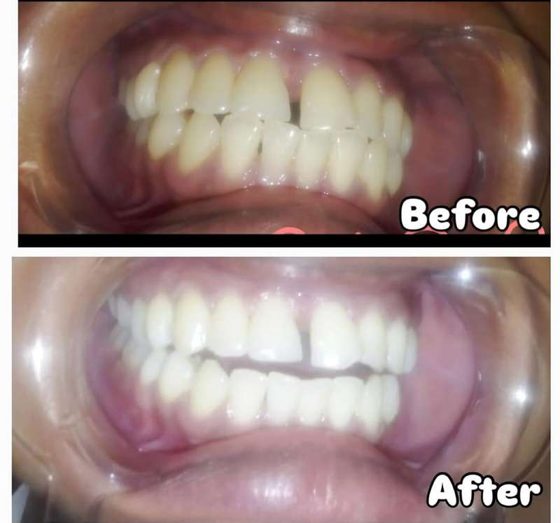 Teeth Whitening Smile Stick