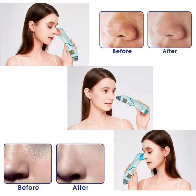 Blackhead Remover Suction Cleaner with Cold Hot Compress LED Display