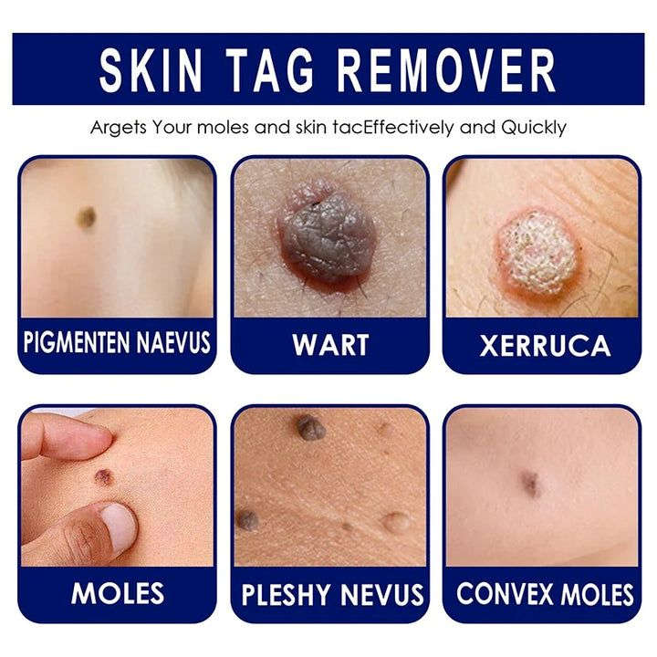 Skin tags removal Cream