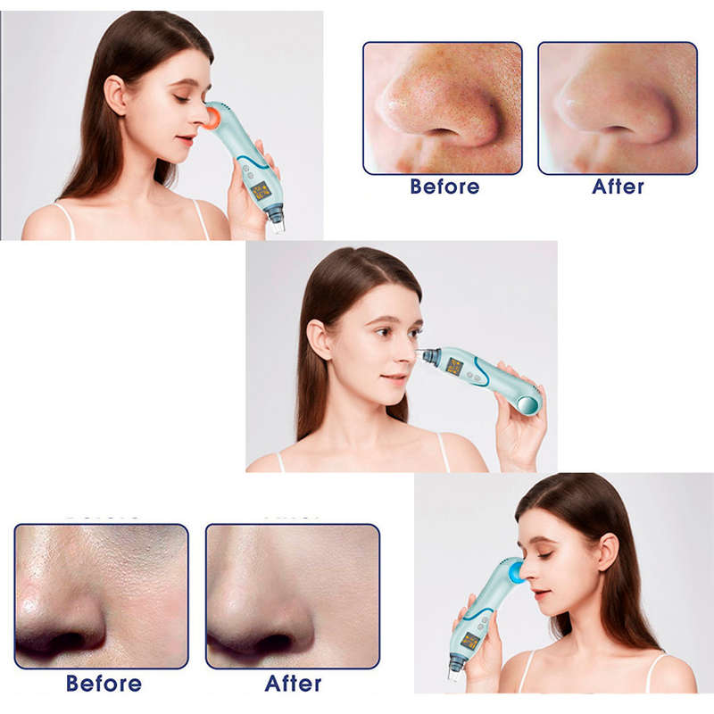 LED Display Blackhead Remover Vacuum Cleaner with Cold Hot Compress