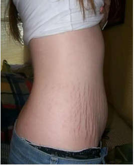 Daqan Stretch Marks Scars Removal Cream