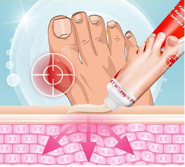 2 Pcs Bunions Pains Relief Cream