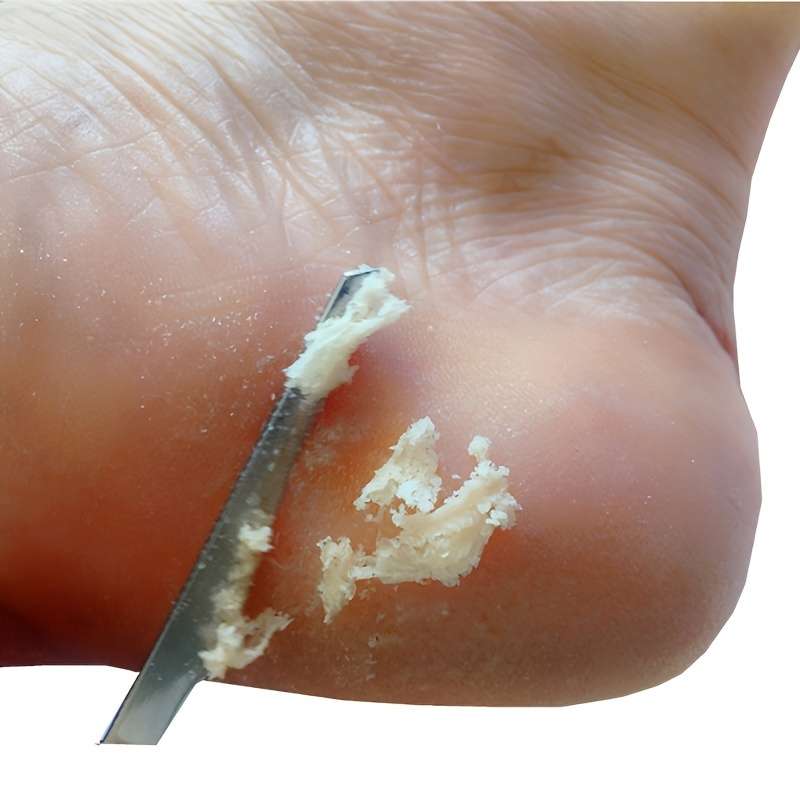 Stainless Steel Pedicure Knife - Professional Foot File For Callus Removal