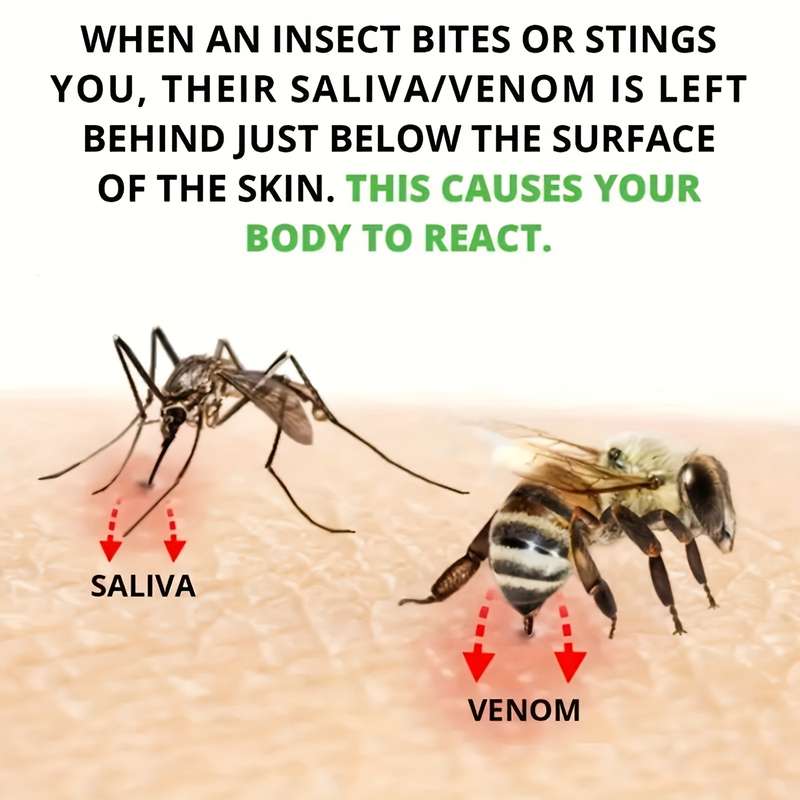 Bug Bite Removal Tool, Portable Venom Extractor