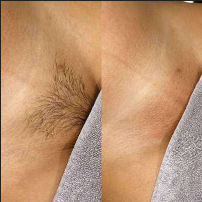 Browns Hair Removal- Threading Machine.
