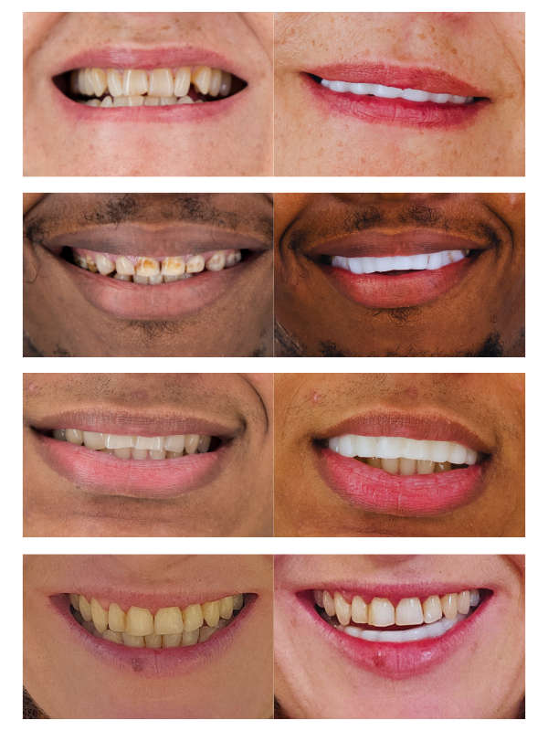 Mend a Smile - Fit your own comfy clip-on clip-off teeth.