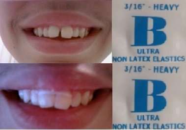 ORTHODONTIC GAP TEETH BANDS 3/16 HEAVY 100 BANDS
