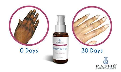 Hands N Feet Gell Corrector For Hydroquinone Damaged Digits. A 7 DAY Bleaching Peel For Hands & Feet