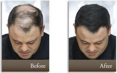 Toppik Hair Building Fibers - Medium Brown 27.5g (75 Day Supply)