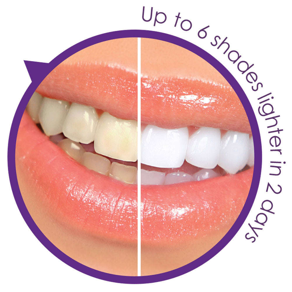 Professional Teeth Whitening Home Kit