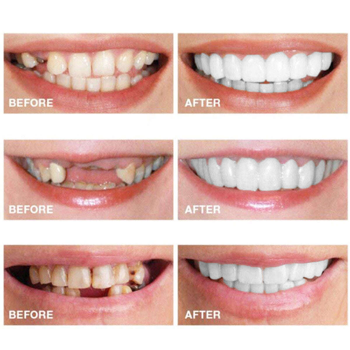 1 Pair Dentistry Cosmetic Covers Smile Comfort Veneers Flex Teeth Braces Upper +Bottom