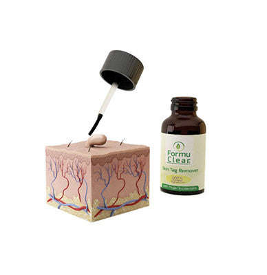 Formu Clear Skin Tag Remover - Easy and Painless!