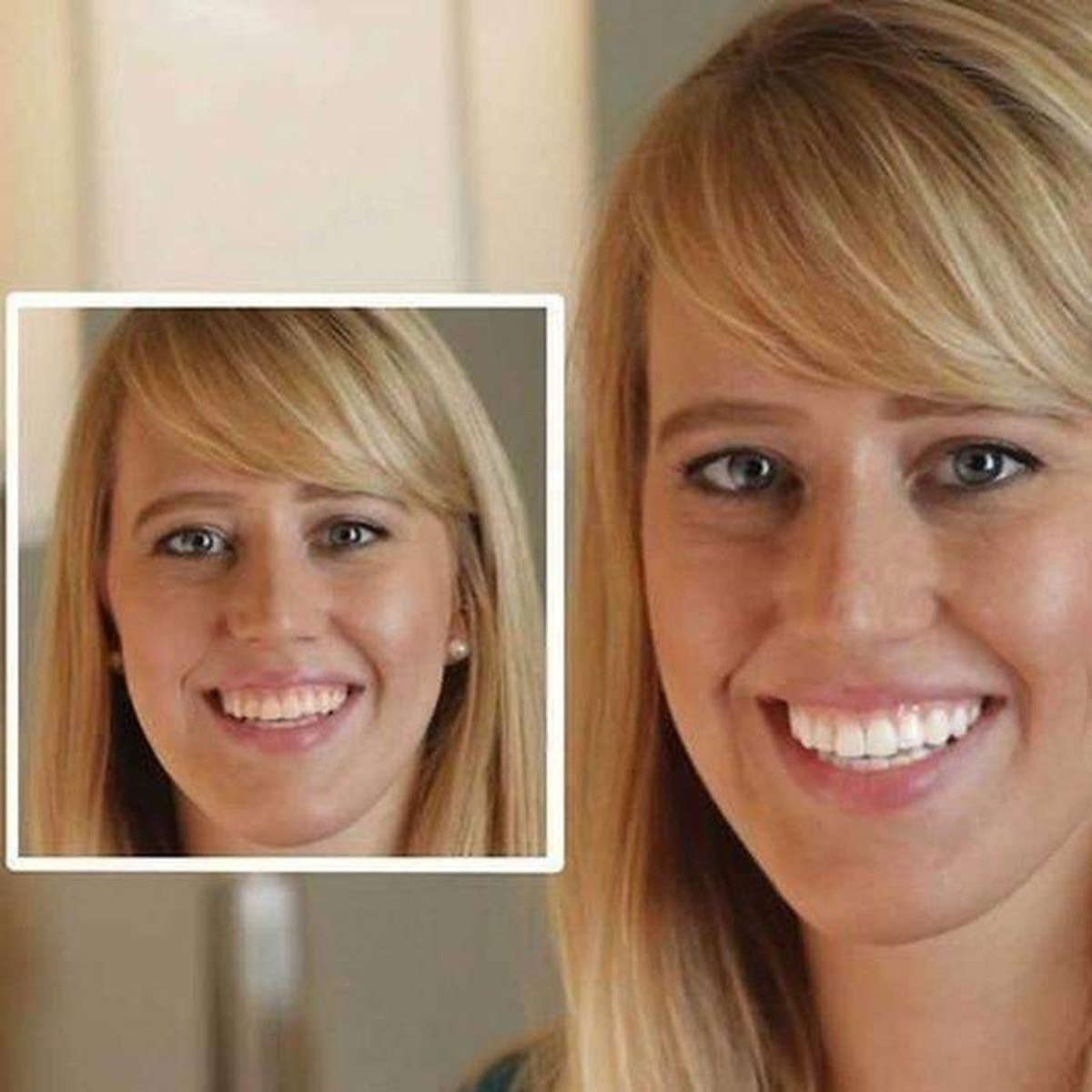 20 Minute Dental Teeth Whitening Kit