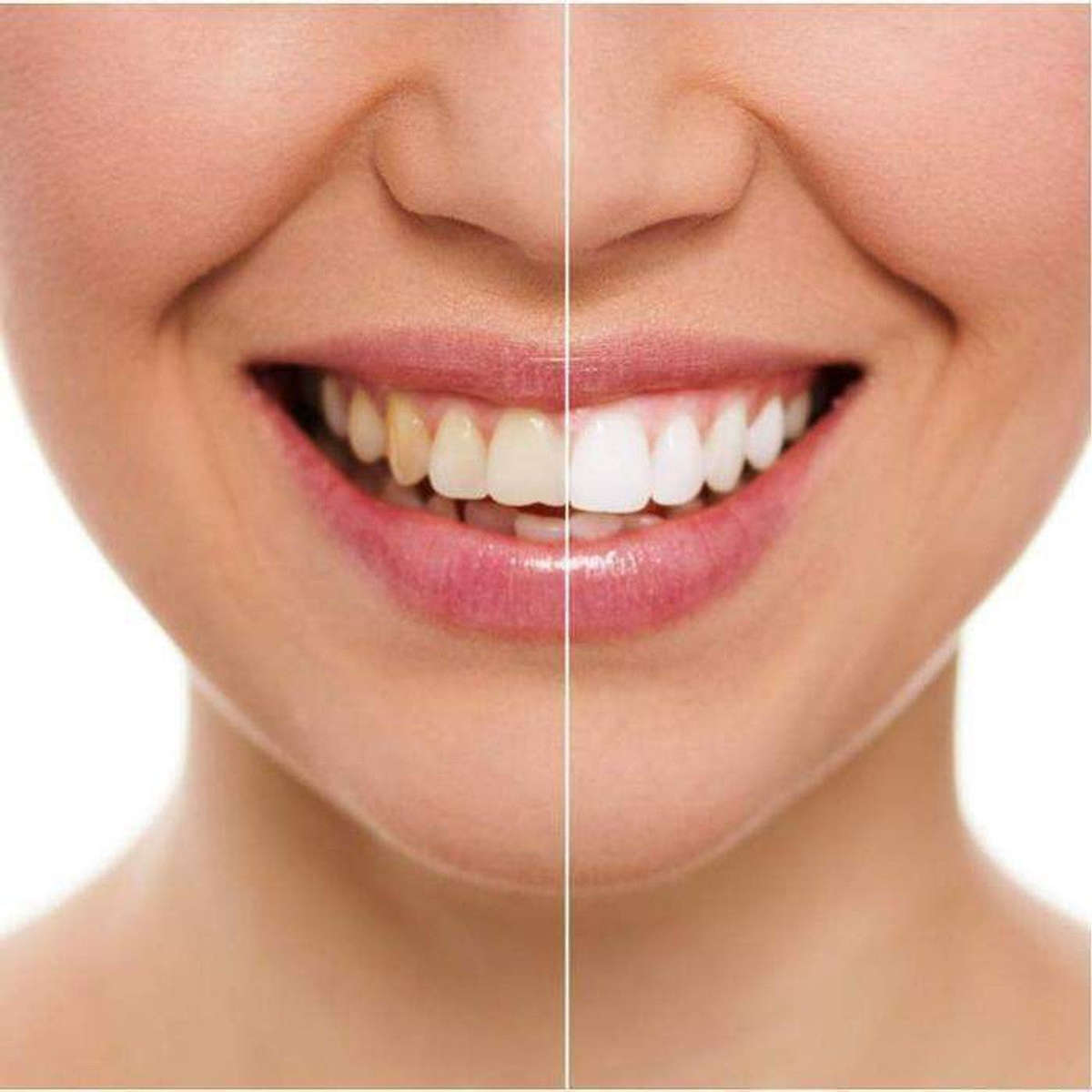 20 Minute Dental Teeth Whitening Kit