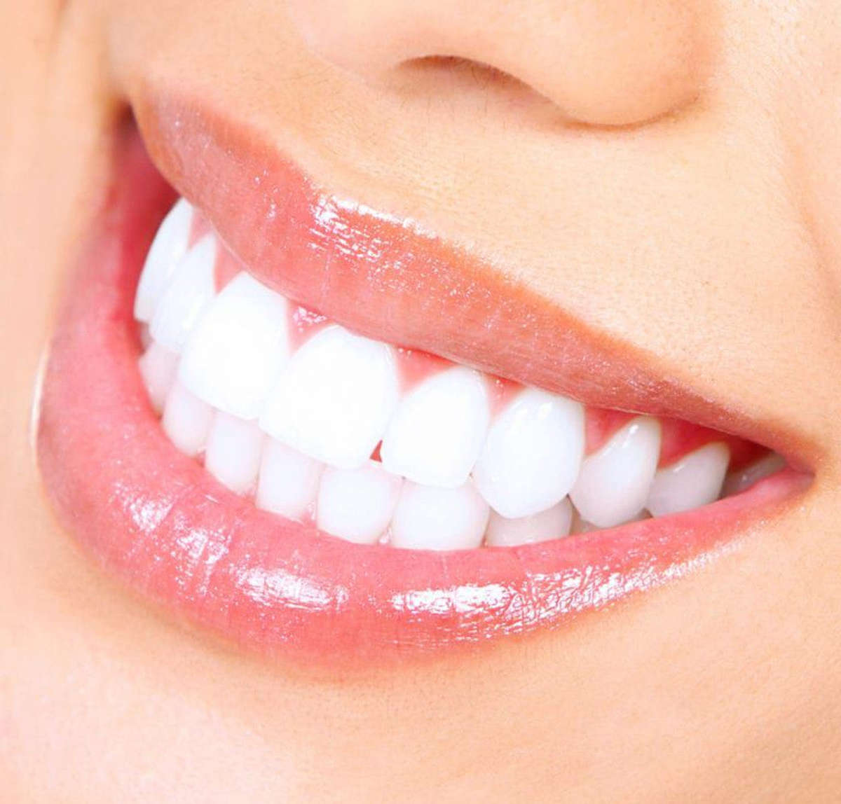 20 Minute Dental Teeth Whitening Kit