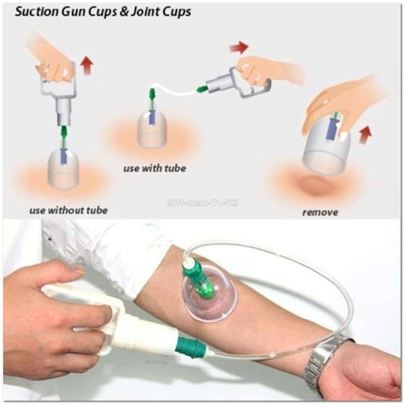 ZS - Vacuum Cupping Sets of 12 Cups With Pump