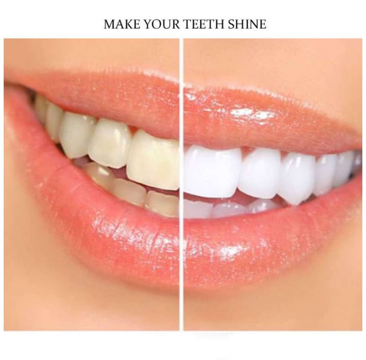 ZS - LED Teeth Whitener & Gel Whitening Kit
