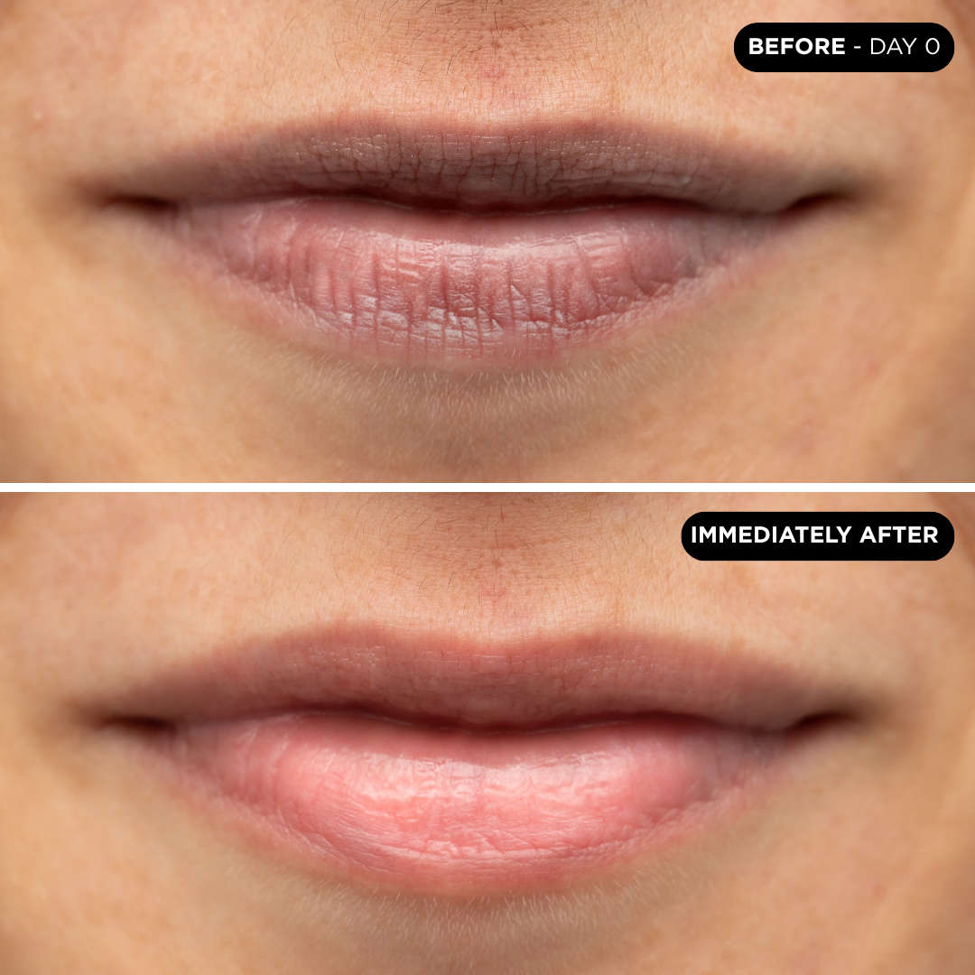 Unicskin - UNICCOLLAGEN VOLUME LIP MASK 5X1 PATCHS