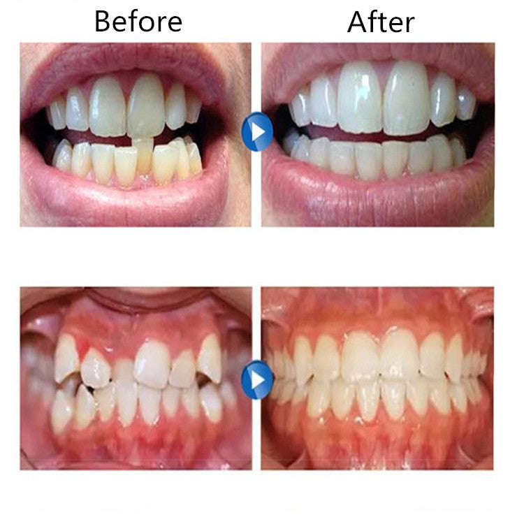 Orthodontic Appliance Silicone Simulation Braces Anti-molar Braces for Night, The first stage, Th...