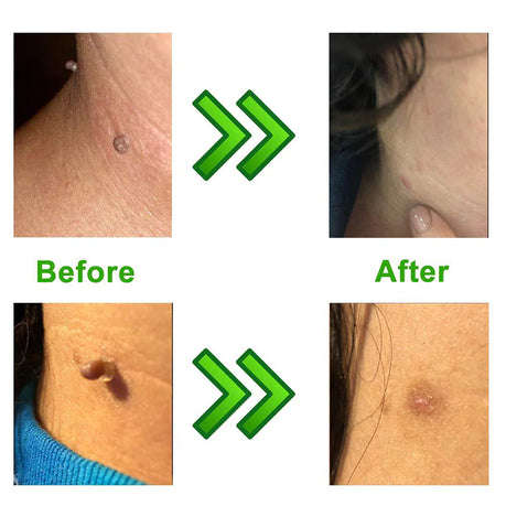 Skin Tag Removal Kit with Micro Bands