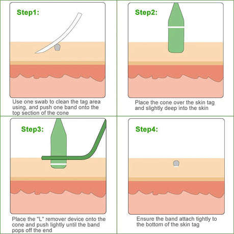 Skin Tag Removal Kit with Micro Bands