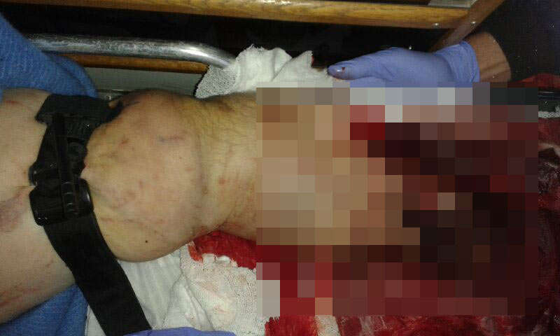 Rotation Compression Tourniquet