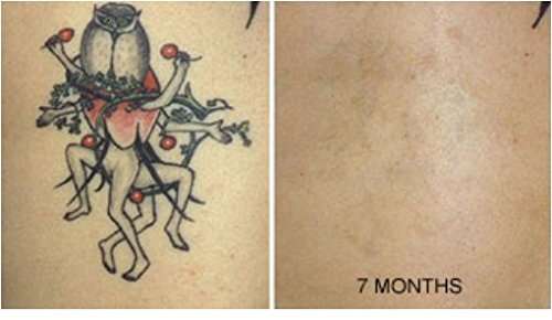 Tattoo Removal Cream Natural Fading system wrecking balm 4 week spartan perform