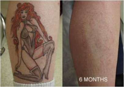 Tattoo Removal Cream Natural Fading system wrecking balm 4 week spartan perform