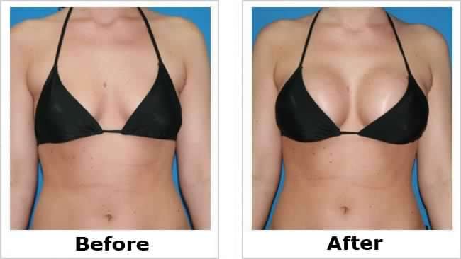 Breast Enlarging Cream